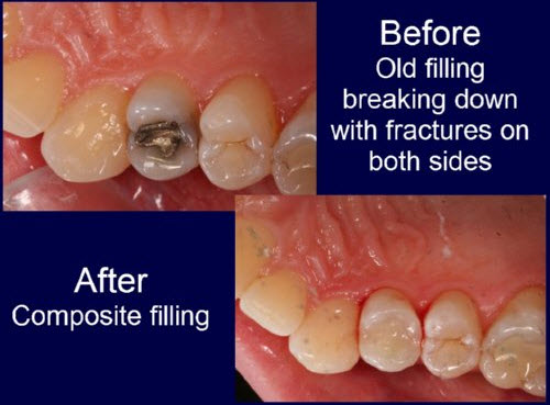 Before and After | Composite Filling