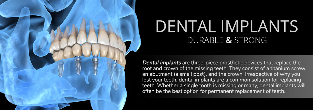 Dental Implants